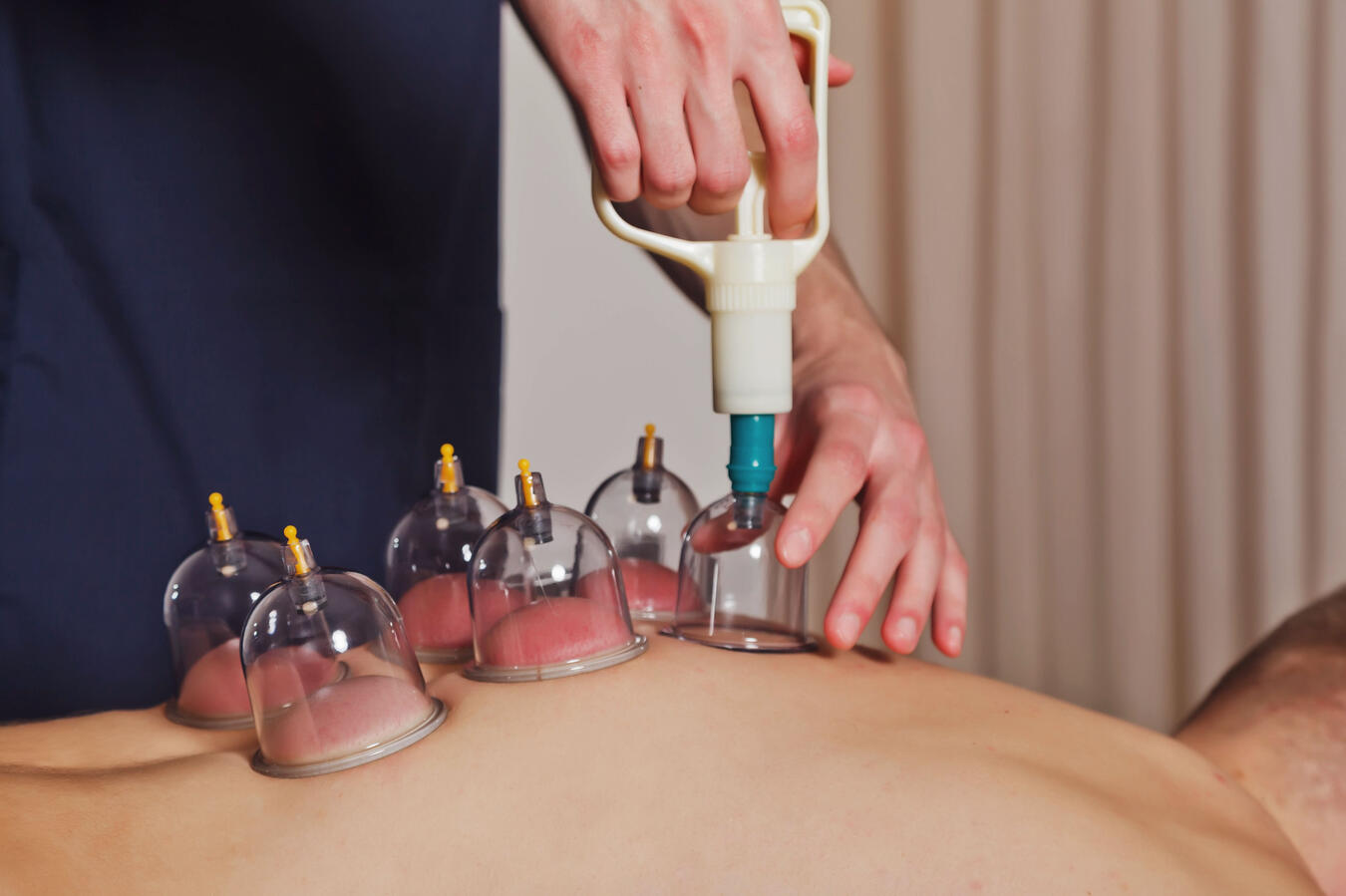 Cupping Cupping